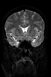Cerebral arteriovenous malformation at posterior body of corpus callosum (Radiopaedia 74111-84925 Coronal T2 62).jpg