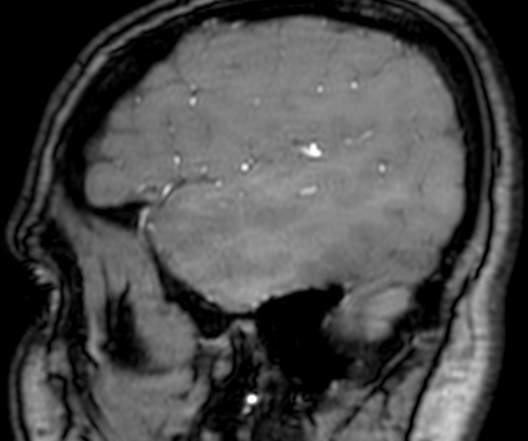 Cerebral arteriovenous malformation at posterior body of corpus callosum (Radiopaedia 74111-84925 J 348).jpg