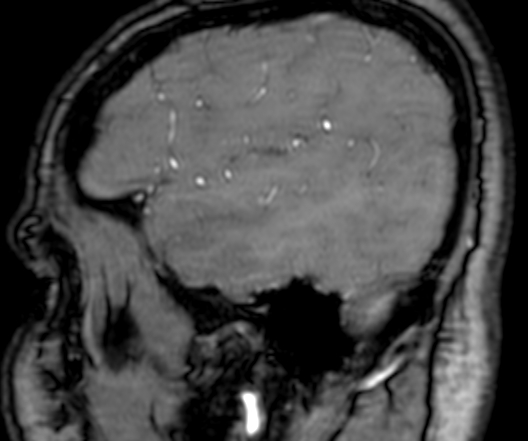 Cerebral arteriovenous malformation at posterior body of corpus callosum (Radiopaedia 74111-84925 J 43).jpg