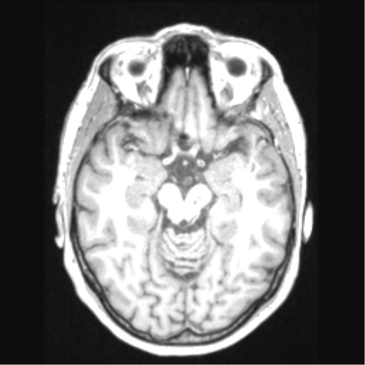 Cerebral arteriovenous malformation with hemorrhage (Radiopaedia 34422-35737 Axial T1 31).png