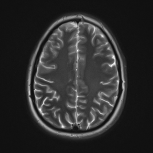 File:Cerebral cavernoma and development venous anomaly (Radiopaedia 37603-39482 Axial T2 16).png