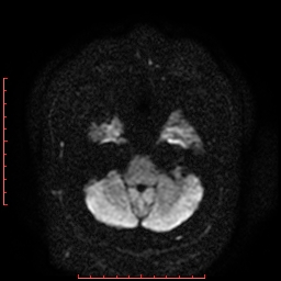 File:Cerebral cavernous malformation (Radiopaedia 26177-26306 Axial DWI 6).jpg