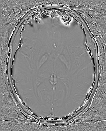 Cerebral cavernous venous malformation (Radiopaedia 70008-80021 G 37).jpg