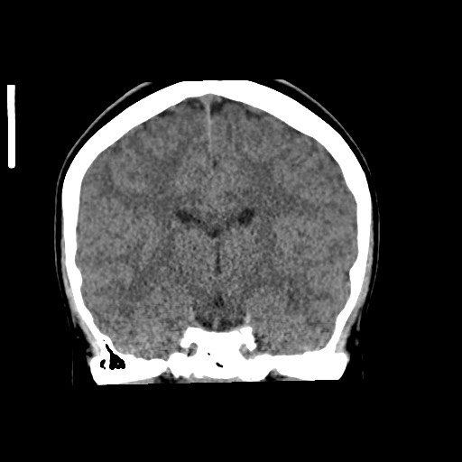 Cerebral cavernous venous malformation (Radiopaedia 70008-80022 non-contrast 38).jpg