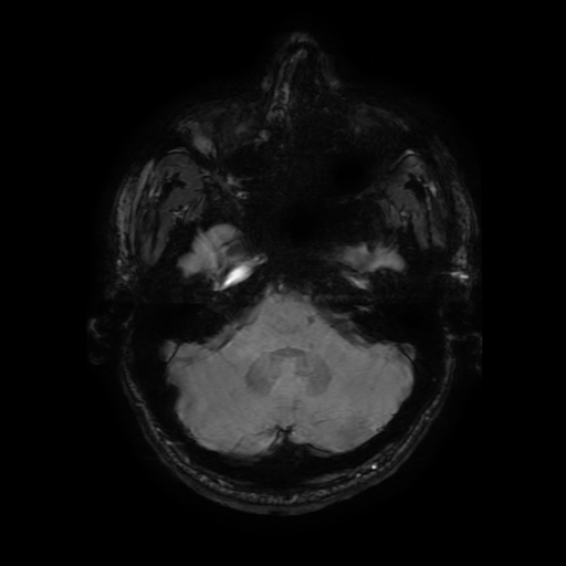 File:Cerebral cavernous venous malformation (Zabramski type II) (Radiopaedia 85511-101198 Axial SWI 34).jpg