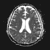 File:Cerebral embolic infarcts (embolic shower) (Radiopaedia 72391-82921 Axial ADC 18).jpg