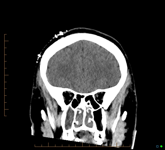 Cerebral fat embolism (Radiopaedia 85521-101224 Coronal non-contrast 19).jpg