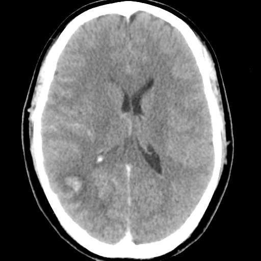 Cerebral hemorrhage secondary to arteriovenous malformation (Radiopaedia 33497-34561 B 31).png