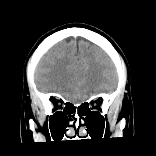 Cerebral hemorrhage secondary to arteriovenous malformation (Radiopaedia 33497-34561 C 18).png