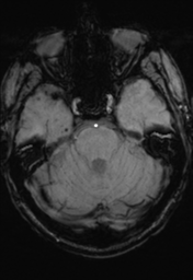 File:Cerebral hemorrhagic contusions- temporal evolution (Radiopaedia 40224-42757 D 11).png