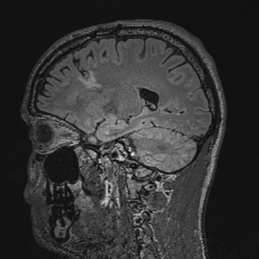 File:Cerebral hemorrhagic contusions- temporal evolution (Radiopaedia 40224-42757 Sagittal T1 30).png