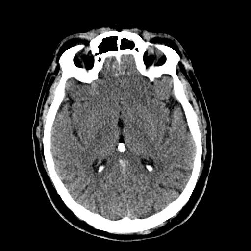 File:Cerebral hemorrhagic contusions and cervical spine fractures (Radiopaedia 32865-33841 Axial non-contrast 18).jpg