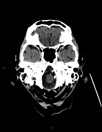 Cerebral metastases - ependymal and parenchymal (Radiopaedia 79877-93131 Axial C+ delayed 12).jpg