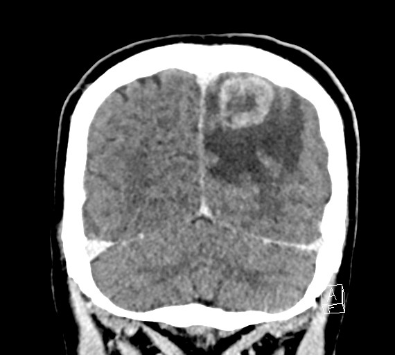 Cerebral metastases - testicular choriocarcinoma (Radiopaedia 84486-99855 D 50).jpg