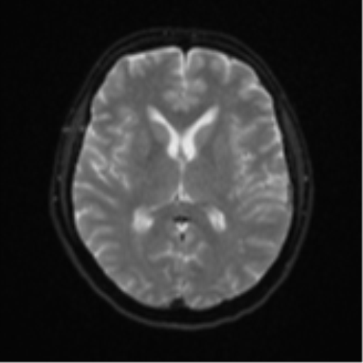 File:Cerebral metastases mimicking abscesses (Radiopaedia 45841-50131 Axial DWI 16).png