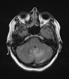 File:Cerebral metastases mimicking abscesses (Radiopaedia 45841-50131 Axial FLAIR 8).png
