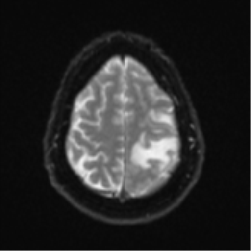 Cerebral metastases mimicking multifocal glioblastoma (Radiopaedia 50843-56353 Axial DWI 22).png