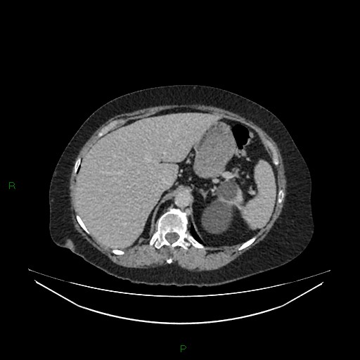 Cerebral metastasis from renal cell carcinoma (Radiopaedia 82306-96378 A 38).jpg