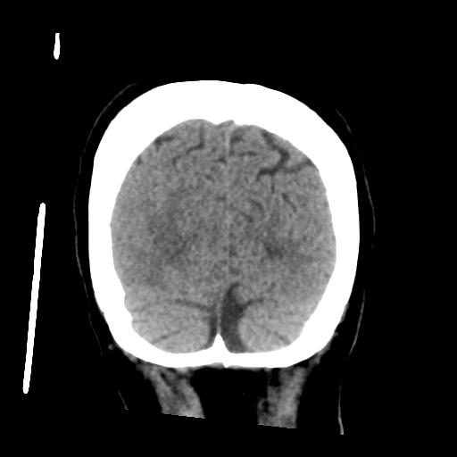 Cerebral metastasis to basal ganglia (Radiopaedia 81568-95412 Coronal non-contrast 56).png