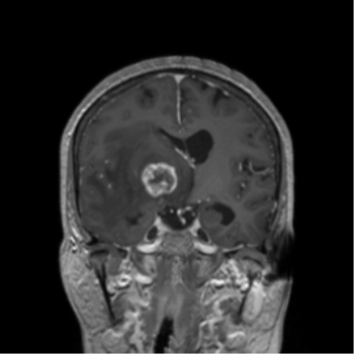 File:Cerebral metastasis to basal ganglia (Radiopaedia 81568-95413 Coronal T1 C+ 29).png
