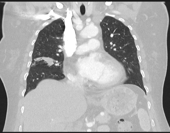File:Cerebral metastasis to basal ganglia (Radiopaedia 81568-95414 Coronal lung window 40).png