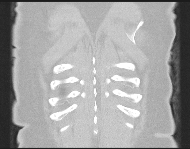 File:Cerebral metastasis to basal ganglia (Radiopaedia 81568-95414 Coronal lung window 76).png