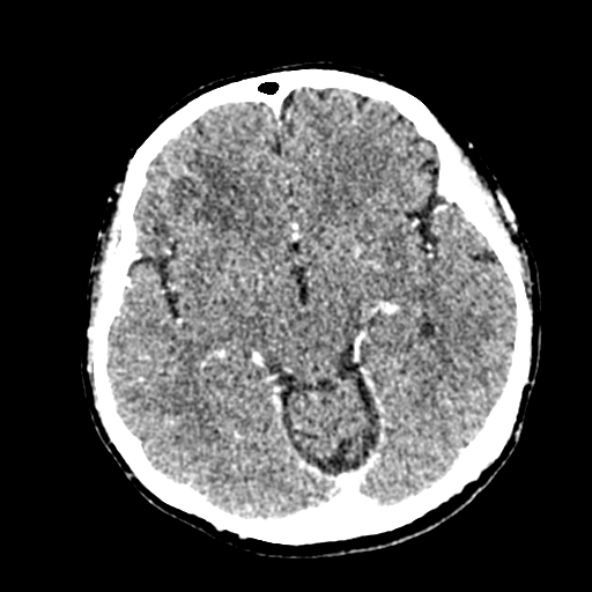 Cerebral ring enhancing lesions - cerebral metastases (Radiopaedia 44922-48818 B 124).jpg