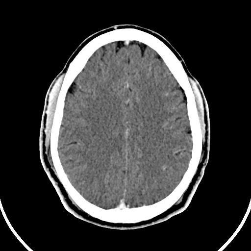File:Cerebral venous angioma (Radiopaedia 69959-79977 B 69).jpg