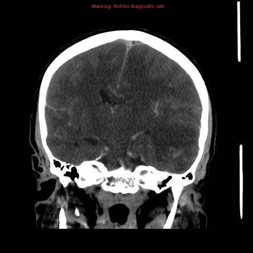 Cerebral venous infarction (Radiopaedia 12404-20735 B 42).jpg