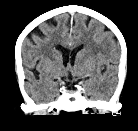 Cerebral venous infarction with hemorrhage (Radiopaedia 65343-74381 Coronal non-contrast 22).jpg