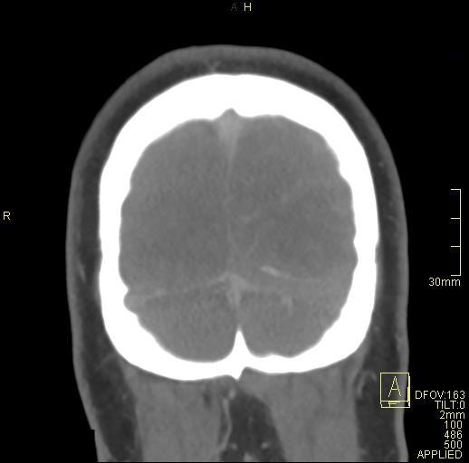 Cerebral venous sinus thrombosis (Radiopaedia 91329-108965 Coronal venogram 79).jpg