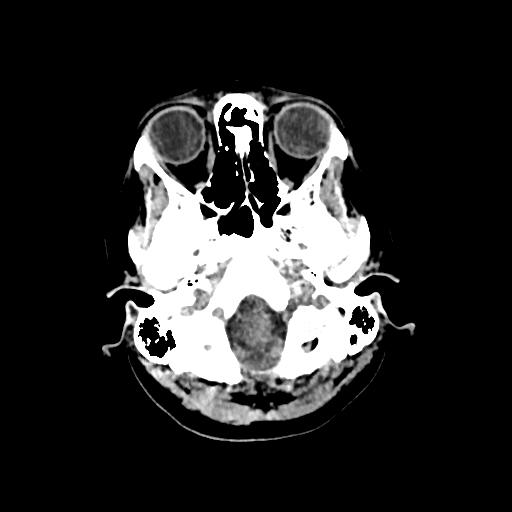 Cerebral venous throbmosis - hemorrhagic venous infarction (Radiopaedia 87318-103613 Axial non-contrast 21).jpg