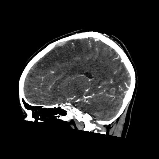 File:Cerebral venous throbmosis - hemorrhagic venous infarction (Radiopaedia 87318-103613 Sagittal CT venogram 18).jpg