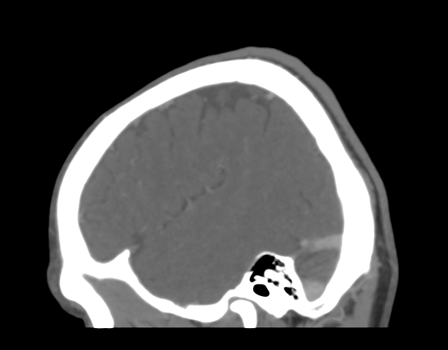 File:Cerebral venous thrombosis (Radiopaedia 38392-40467 D 43).png