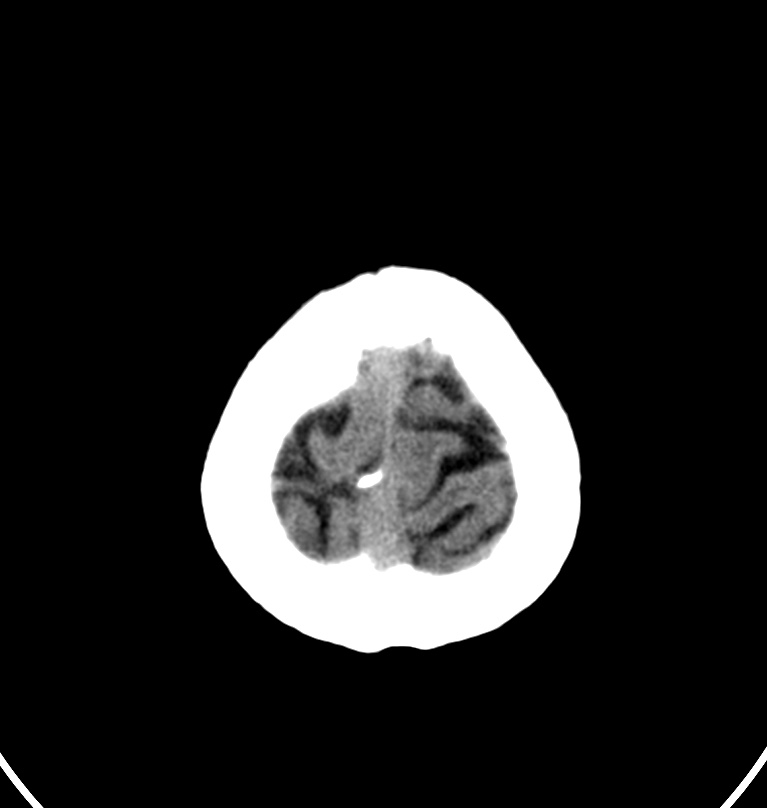 Cerebral venous thrombosis - CT only (Radiopaedia 41031-43778 Axial non-contrast 1).jpg