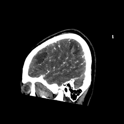File:Cerebral venous thrombosis - hemorrhagic venous infarction (Radiopaedia 87318-103613 Sagittal 33).jpg