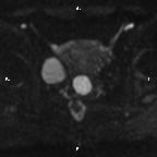 Cervical adenocarcinoma (Radiopaedia 65011-73985 Axial DWI 44).jpg
