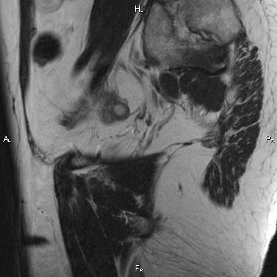 File:Cervical adenocarcinoma (Radiopaedia 65011-73985 Sagittal T2 5).jpg