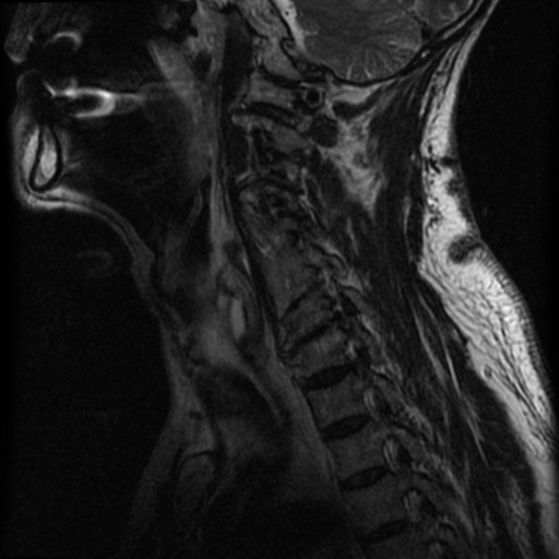 File:Cervical canal stenosis with cord compression (Radiopaedia 34114-35374 Sagittal T2 4).png
