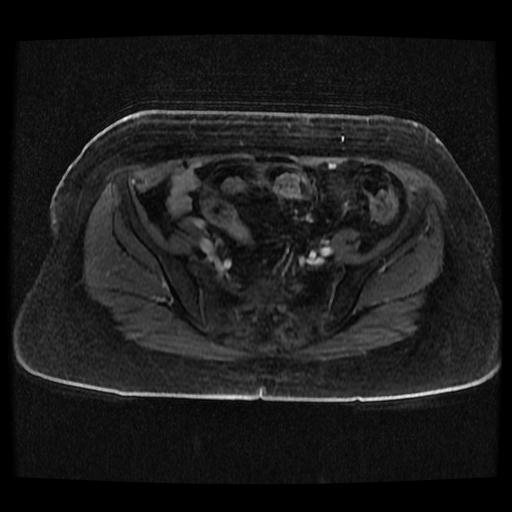 Cervical carcinoma (Radiopaedia 70924-81132 Axial T1 C+ fat sat 156).jpg