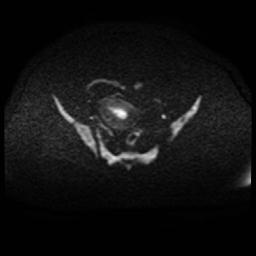 Cervical carcinoma (Radiopaedia 88010-104555 Axial DWI 75).jpg