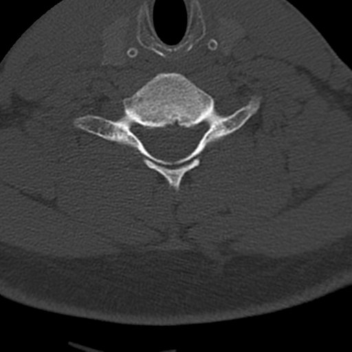 File:Cervical schwannoma (Radiopaedia 57979-64974 Axial bone window 35).png