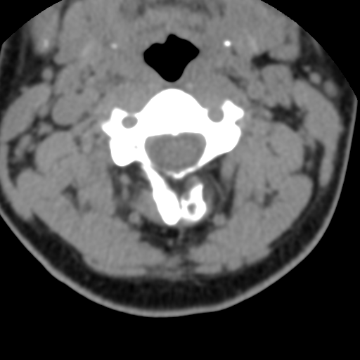 Cervical schwannoma (Radiopaedia 57979-64974 Axial non-contrast 25).png