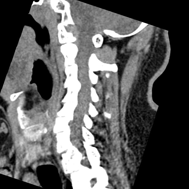 Cervical spinal neurofibroma in a patient with NF1 (Radiopaedia 58344-65464 C 32).jpg