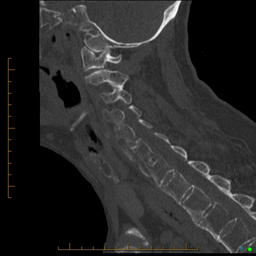 Cervical spine fracture - ankylosing spondylitis (Radiopaedia 76835-88706 Sagittal bone window 45).jpg