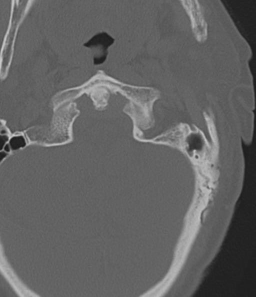File:Cervical spine fracture in the setting of ankylosis (Radiopaedia 37038-38715 Axial bone window 11).png