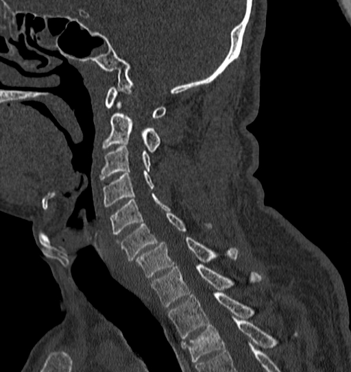 Cervical spine trauma with tear drop fracture and perched facet joint (Radiopaedia 53989-60127 Sagittal bone window 65).jpg