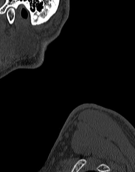 Cervical spondylodiscitis (Radiopaedia 28057-29489 Sagittal bone window 1).jpg