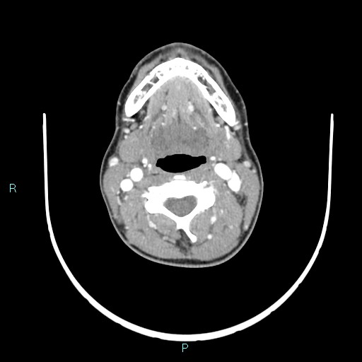 Cervical thymic cyst (Radiopaedia 88632-105335 B 71).jpg