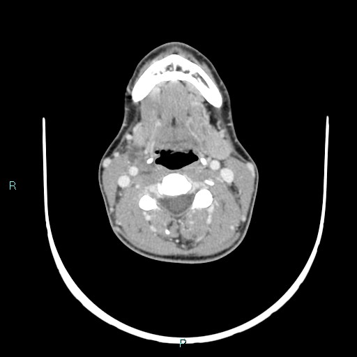 Cervical thymic cyst (Radiopaedia 88632-105335 C 67).jpg